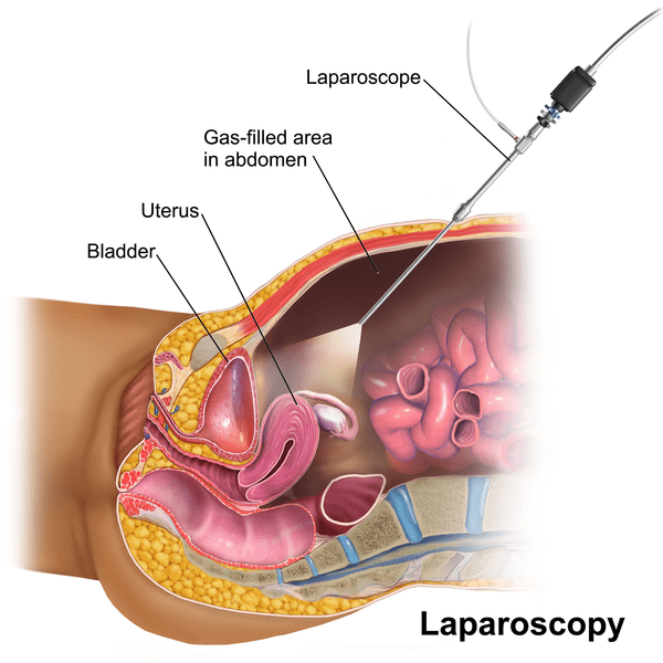 ¿Cuál es la diferencia entre histeroscopia y laparoscopia?